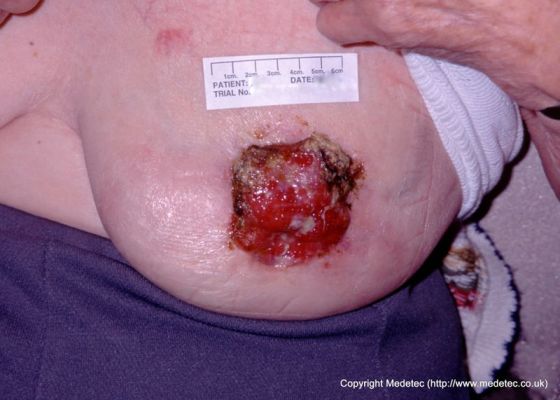 Fungating breast wound prior to radiotherapy